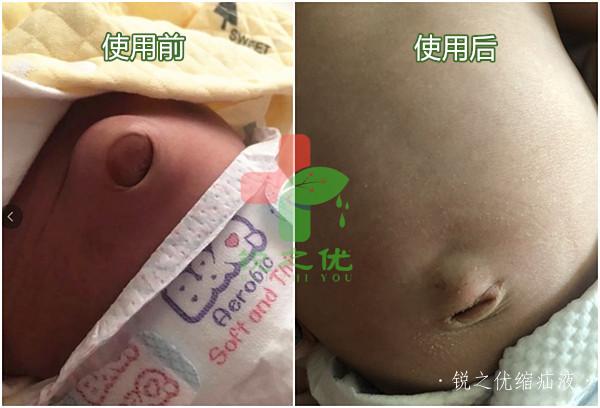 宝宝脐疝用锐之优二联套装一个月恢复了（前后对比） 第1张